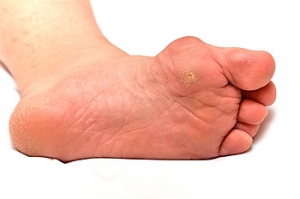 Possible Causes of Bunions
