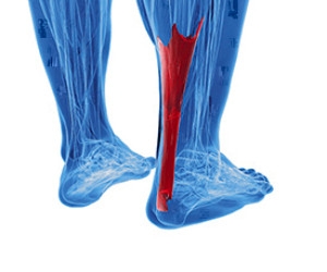 What Causes Achilles Tendonitis?