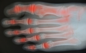 Arthritis: What Causes It &amp; How to Treat It
