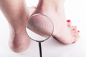 Are Cracked Heels A Common Foot Condition?