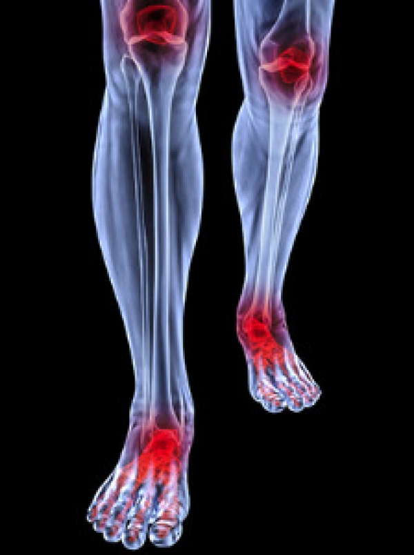 Ankle arthritis: what is subtalar arthritis