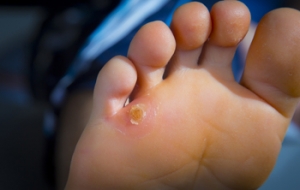Proper Treatment for Corns